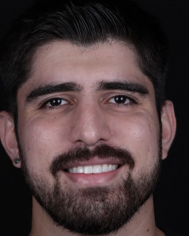 Paciente sorrindo após a transformação do sorriso